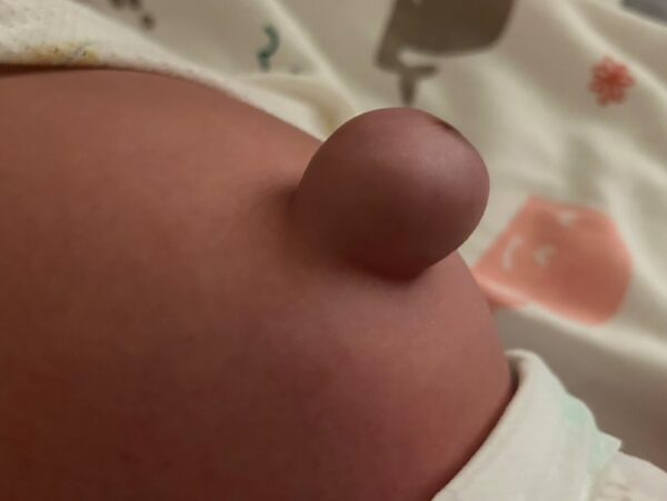 臍疝氣是新生嬰兒常見的健康問題之一。圖／曾璟星