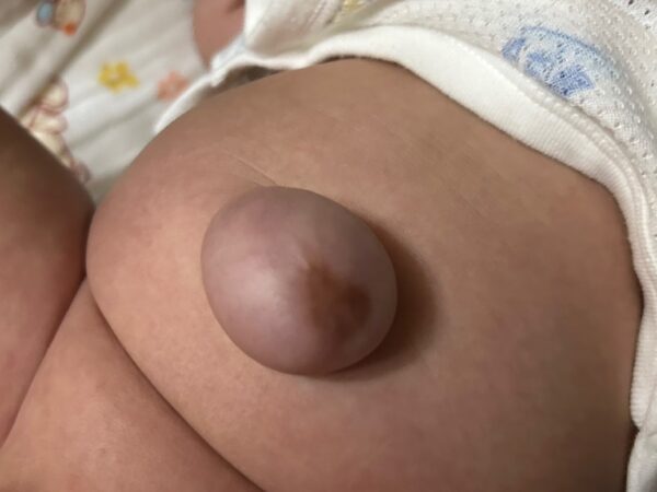 新生嬰兒常見臍疝氣。圖／曾璟星